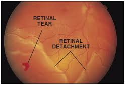 What are the symptoms of a torn retina?